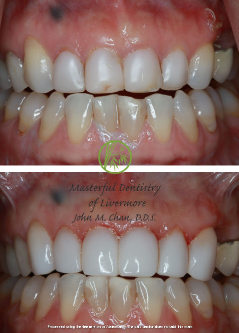Bioclear featured case 1 — before and after