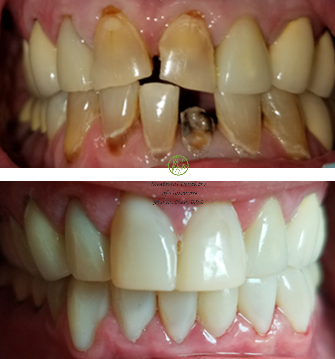 Bioclear case 13 — gap and shape correction