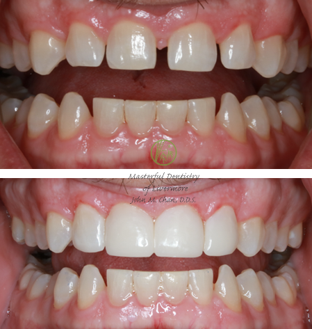 Bioclear case 16 — full smile refinement