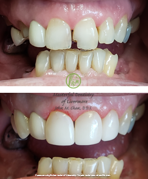 Bioclear featured case 2 — before and after