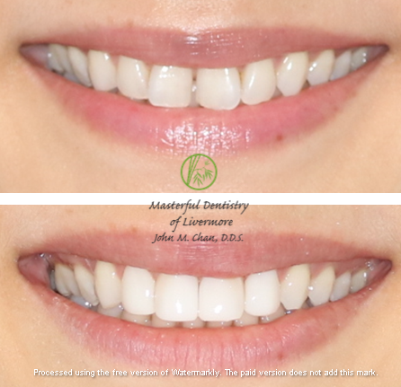 Bioclear case 3 — gap closure