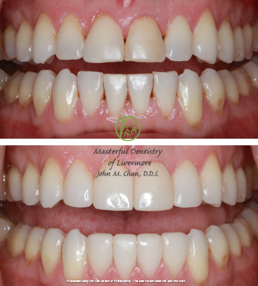 Bioclear case 4 — black triangle correction