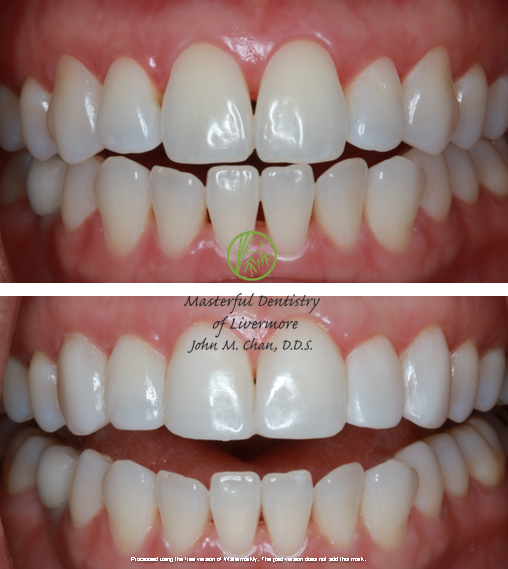 Bioclear case 5 — smile makeover