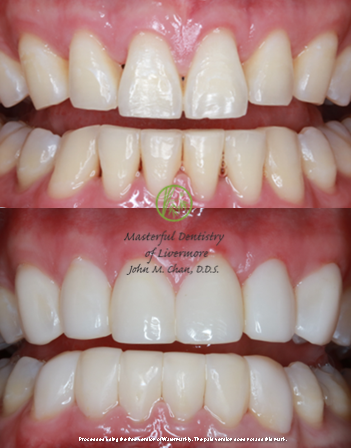 Bioclear case 9 — worn teeth restored