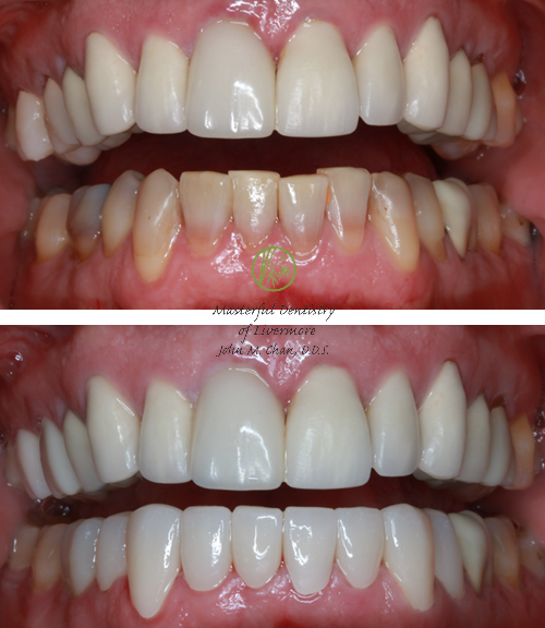 Crown case 2 — broken tooth crown