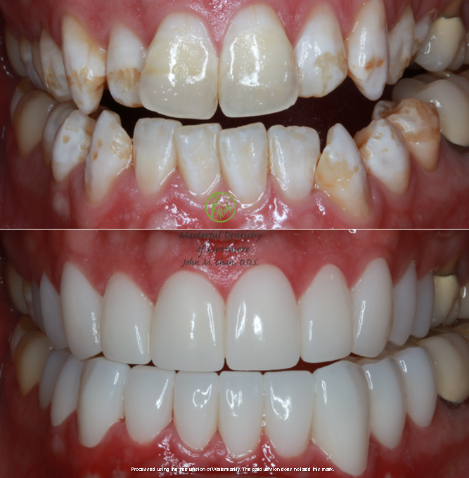 Crown case 3 — full coverage restoration